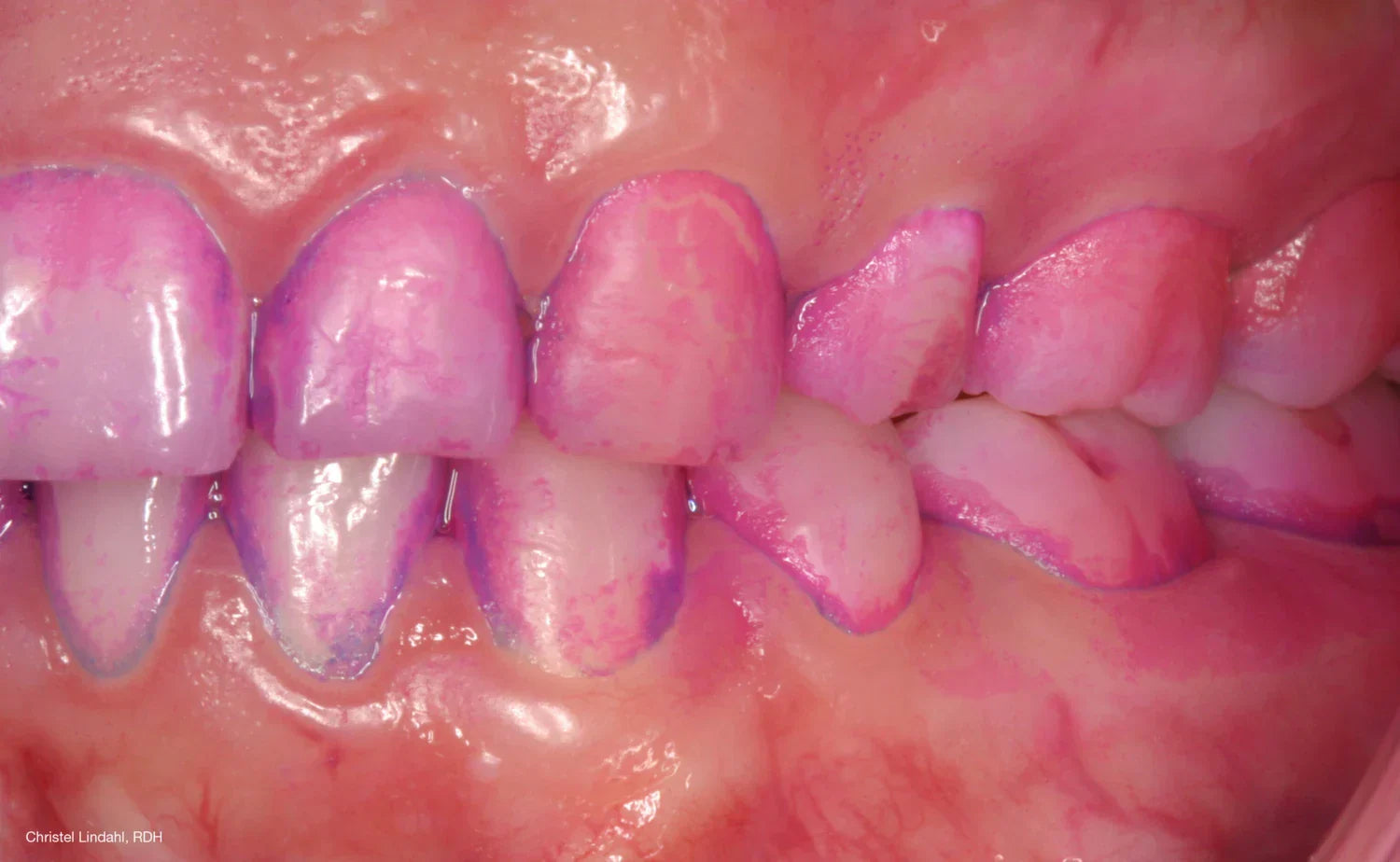 每天都有刷牙，為什麼牙菌斑還是一直長回來？