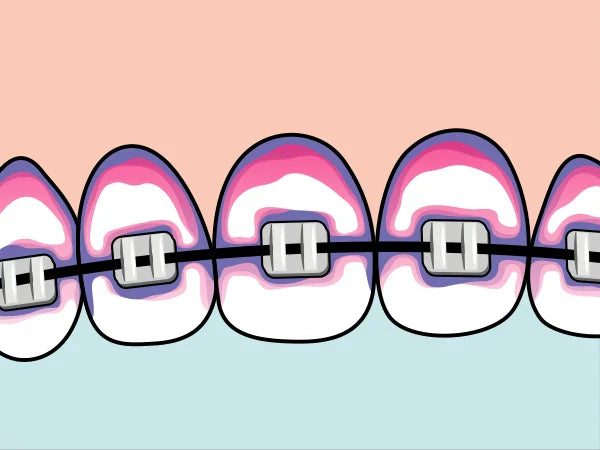 矯正、植牙、牙橋族群更需要牙菌斑顯示錠的 4 個原因