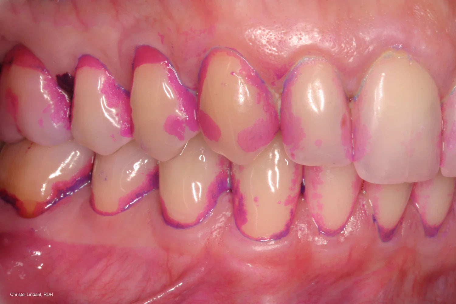 牙菌斑顯示錠 vs 顯示液：哪一種更適合居家檢查？