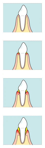 牙菌斑多久會變牙結石？掌握 7 到 14 天的關鍵清潔黃金期